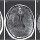 Imágenes por resonancia magnética que se centran en una de las tres lesiones cerebrales
